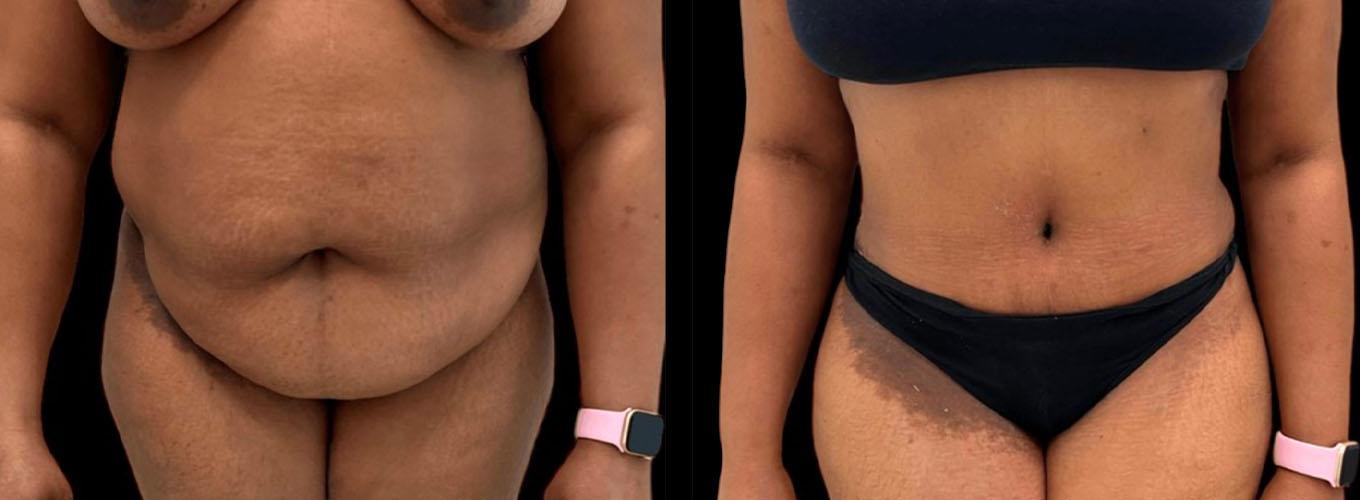 Inspire Aesthetics tummy tuck result — Delray Beach, FL