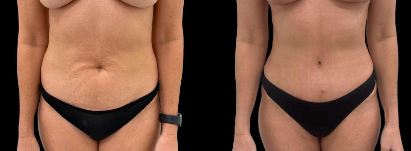 Inspire Aesthetics tummy tuck result — Delray Beach, FL