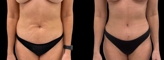 Mini Tummy Tuck result at Inspire Aesthetics in Delray Beach, FL