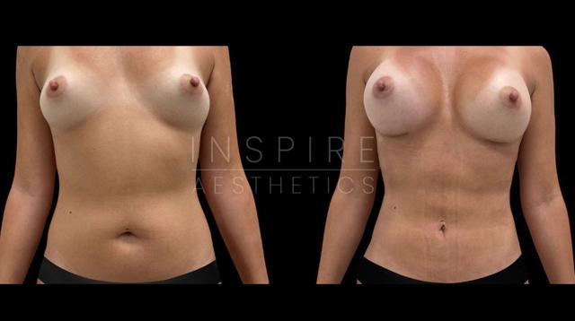 Mommy Makeover result at Inspire Aesthetics in Delray Beach, FL