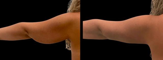 Arm Lift result at Inspire Aesthetics in Delray Beach, FL