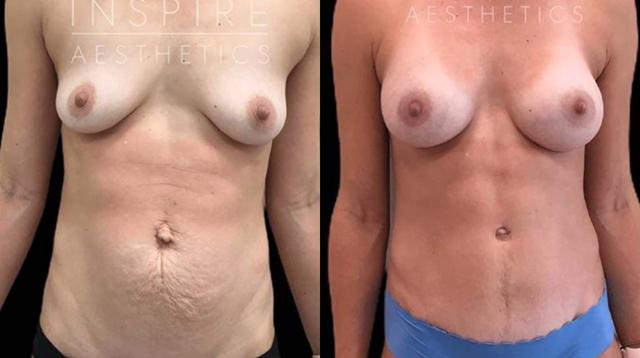 Mommy Makeover result at Inspire Aesthetics in Delray Beach, FL
