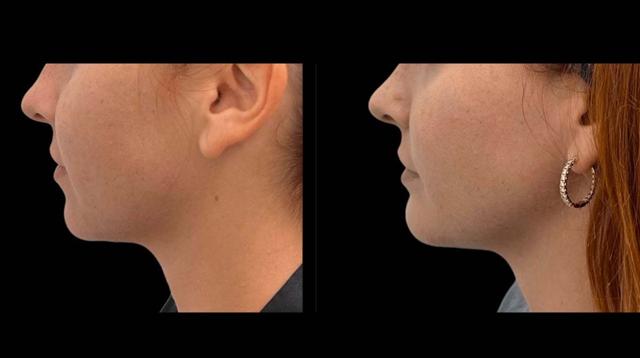 Chin Implant result at Inspire Aesthetics in Delray Beach, FL