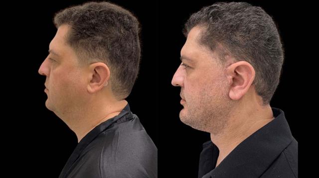 Chin Implant result at Inspire Aesthetics in Delray Beach, FL