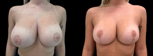 Breast Reduction result at Inspire Aesthetics in Delray Beach, FL