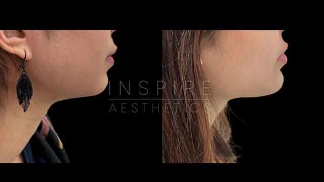 Chin Implant result at Inspire Aesthetics in Delray Beach, FL