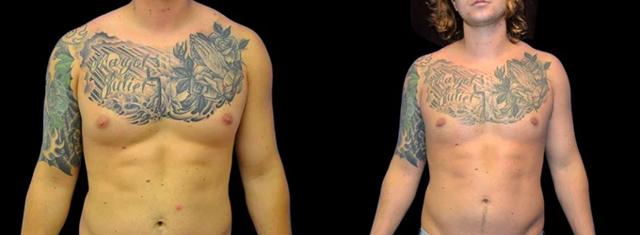 Gynecomastia Surgery result at Inspire Aesthetics in Delray Beach, FL