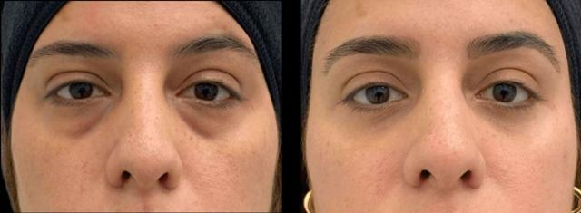 Blepharoplasty result at Inspire Aesthetics in Delray Beach, FL