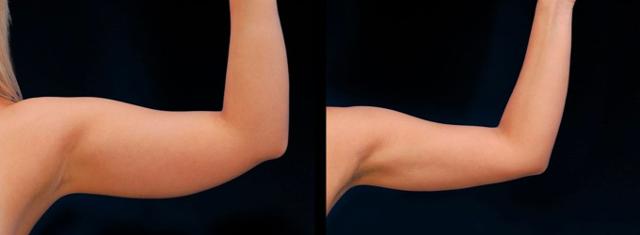 Arm Lift result at Inspire Aesthetics in Delray Beach, FL