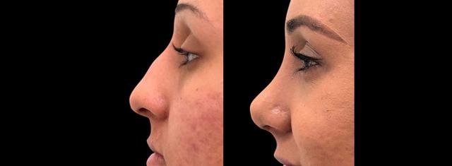 Rhinoplasty result at Inspire Aesthetics in Delray Beach, FL