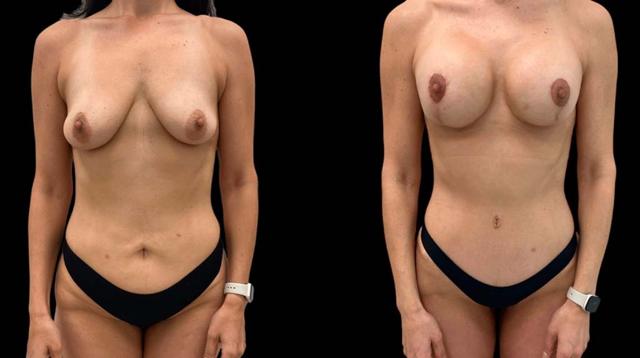 Mommy Makeover result at Inspire Aesthetics in Delray Beach, FL
