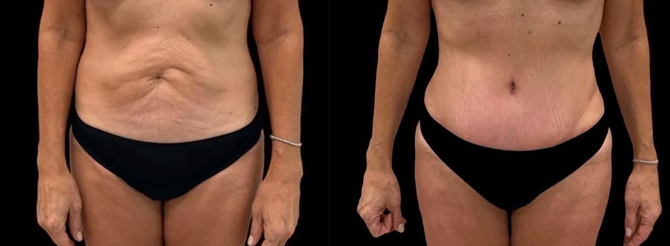 Inspire Aesthetics tummy tuck result — Delray Beach, FL