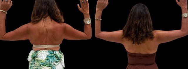 Arm Lift result at Inspire Aesthetics in Delray Beach, FL