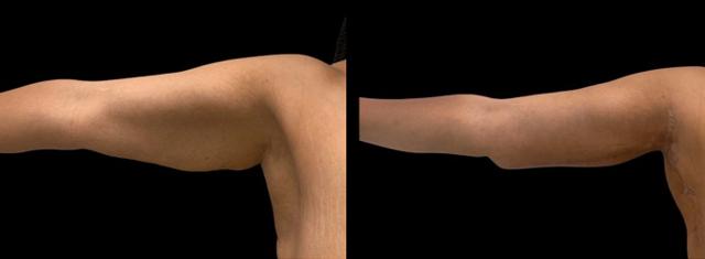 Arm Lift result at Inspire Aesthetics in Delray Beach, FL
