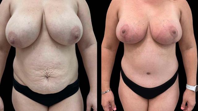 Mommy Makeover result at Inspire Aesthetics in Delray Beach, FL