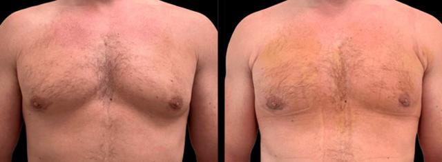 Gynecomastia Surgery result at Inspire Aesthetics in Delray Beach, FL