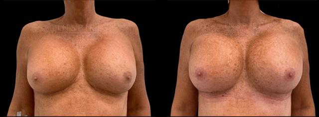 Breast Augmentation result at Inspire Aesthetics in Delray Beach, FL