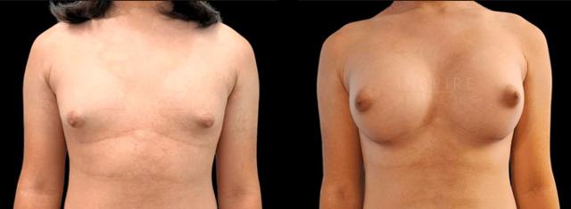 Breast Augmentation result at Inspire Aesthetics in Delray Beach, FL