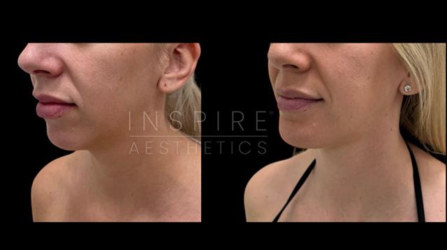 Chin Implant result at Inspire Aesthetics in Delray Beach, FL
