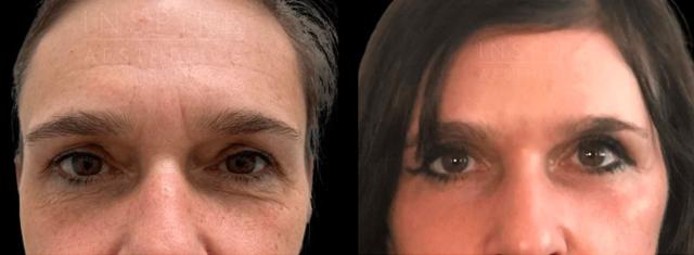 Blepharoplasty result at Inspire Aesthetics in Delray Beach, FL