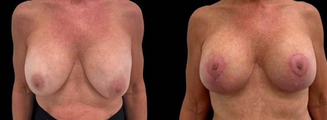 Breast Lift result at Inspire Aesthetics in Delray Beach, FL