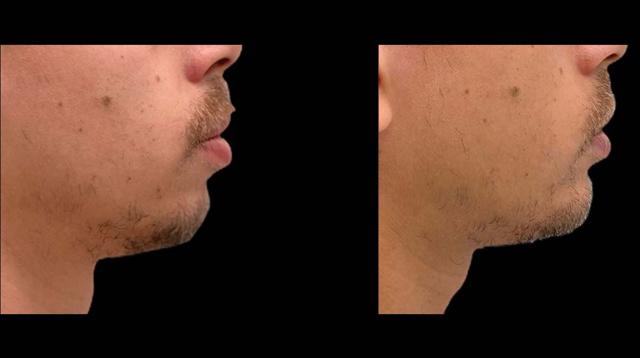 Chin Implant result at Inspire Aesthetics in Delray Beach, FL