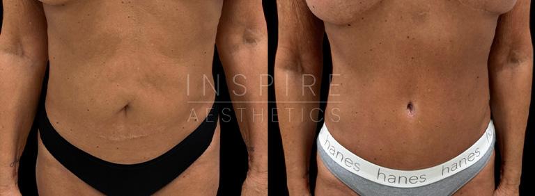 Inspire Aesthetics tummy tuck result — Delray Beach, FL