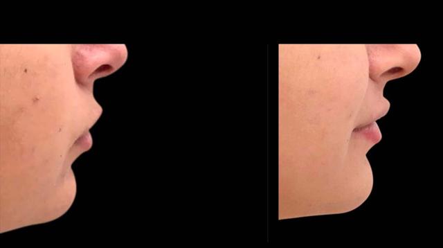 Chin Implant result at Inspire Aesthetics in Delray Beach, FL