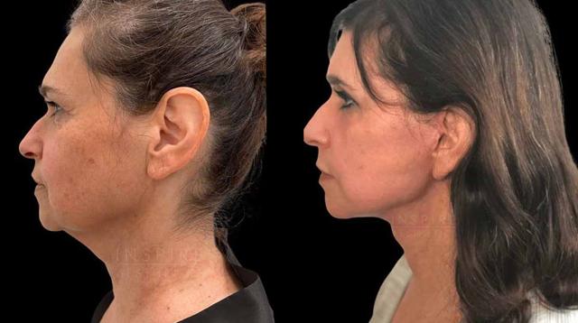Neck Lift result at Inspire Aesthetics in Delray Beach, FL