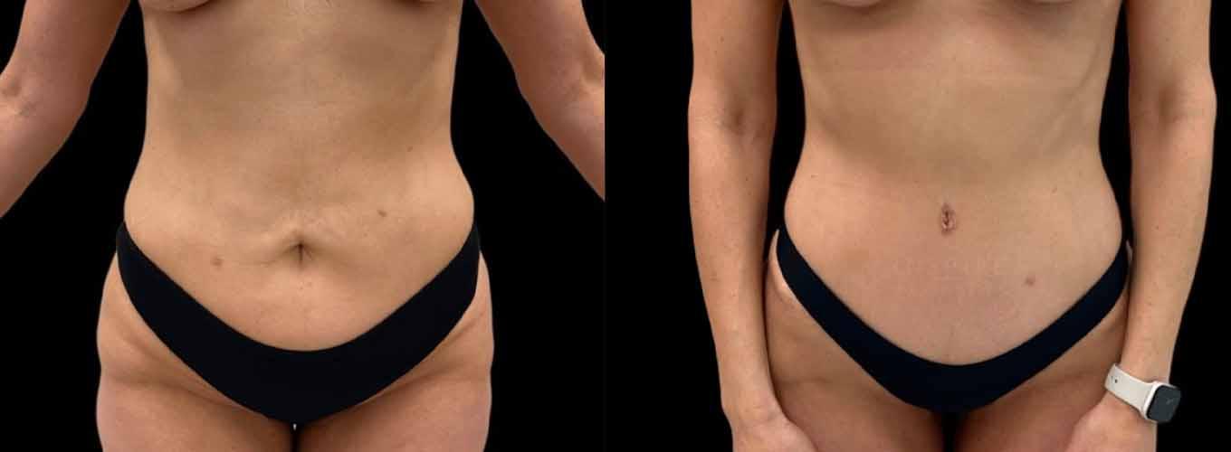 Inspire Aesthetics tummy tuck result — Delray Beach, FL