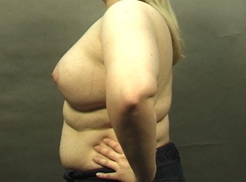 Breast Lift after at Khan Plastic Surgery in Dallas, TX