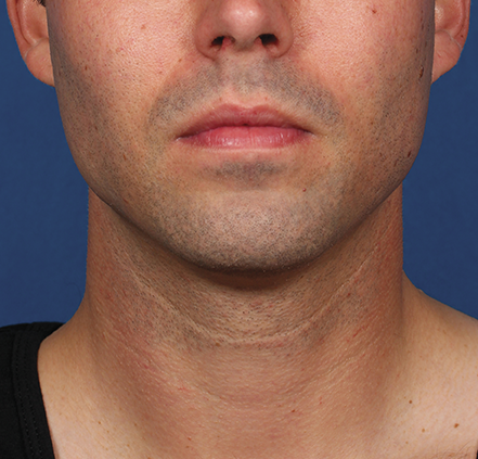 Khan Plastic Surgery after — Dallas, TX