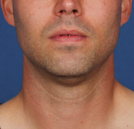 Neck Liposuction before at Khan Plastic Surgery in Dallas, TX