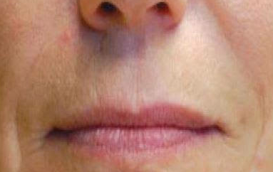 Khan Plastic Surgery after — Dallas, TX