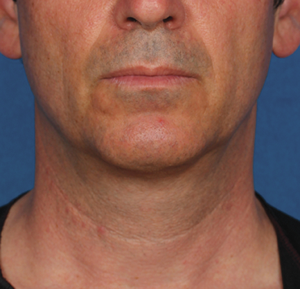 Khan Plastic Surgery after — Dallas, TX
