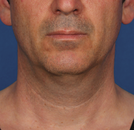 Neck Liposuction before at Khan Plastic Surgery in Dallas, TX