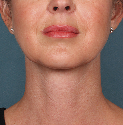 Khan Plastic Surgery after — Dallas, TX