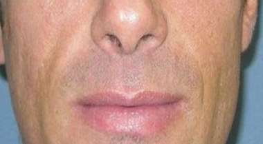 Lip Filler after at Khan Plastic Surgery in Dallas, TX