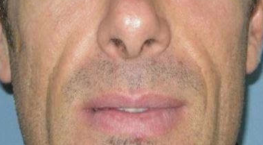 Lip Filler before at Khan Plastic Surgery in Dallas, TX
