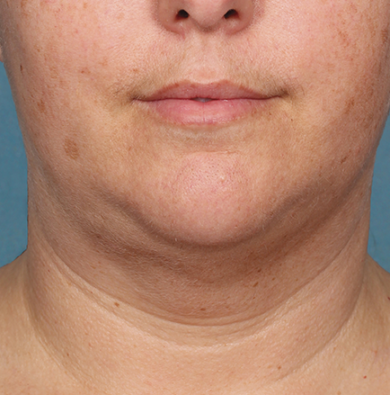 Khan Plastic Surgery after — Dallas, TX