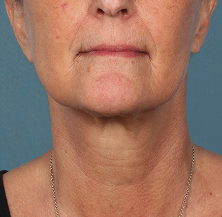 Khan Plastic Surgery after — Dallas, TX