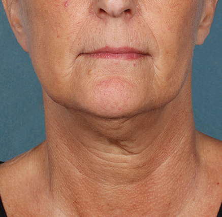 Neck Liposuction before at Khan Plastic Surgery in Dallas, TX