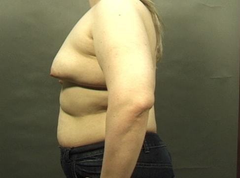 Breast Lift before at Khan Plastic Surgery in Dallas, TX