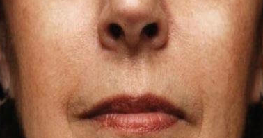 Khan Plastic Surgery after — Dallas, TX