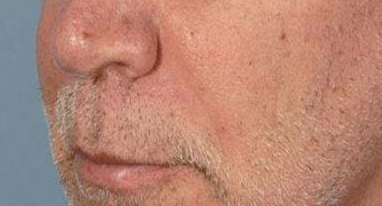 Khan Plastic Surgery after — Dallas, TX