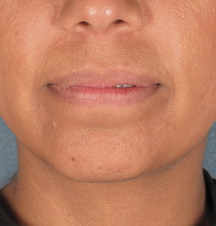Khan Plastic Surgery after — Dallas, TX
