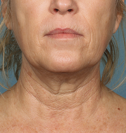 Khan Plastic Surgery after — Dallas, TX
