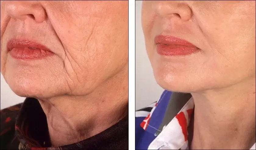 Denenberg Facial Plastic Surgery facelift result — Omaha, NE