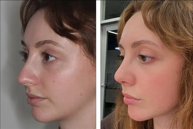 Rhinoplasty result at Denenberg Facial Plastic Surgery in Omaha, NE