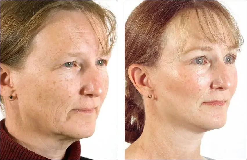 Denenberg Facial Plastic Surgery facelift result — Omaha, NE